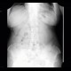 Renal carcinoma, Grawitz tumour: X-ray - Plain radiograph